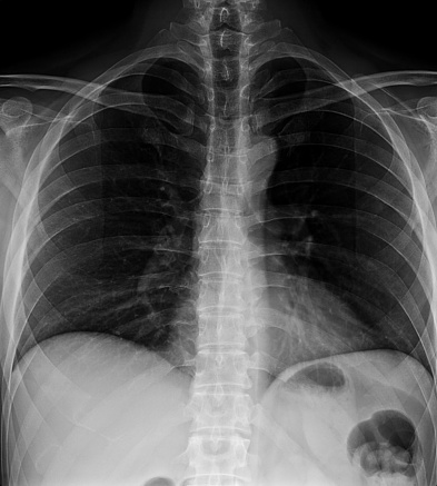 Radiology abnormality detection systems and lung cancer